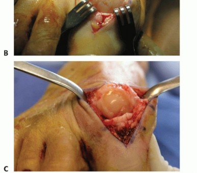Illustration 4 for End Articular Cartilage Loss: Arthrosurface HemiCAP Resurfacing