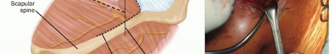 Illustration 15 for Decompressing the Transverse Scapular Ligament for Shoulder Pain Relief