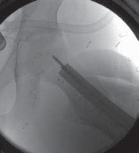 Illustration 16 for Increased Femoral Anteversion: A Proximal Femoral Rotational Osteotomy