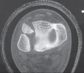 Illustration 23 for Pediatric Ankle Fractures: Management to Prevent Long-Term Issues