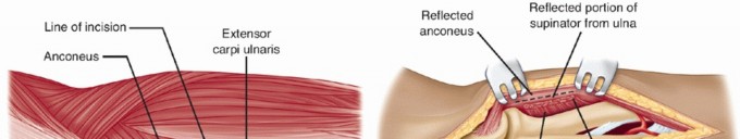 Illustration 52 for Surgical Approaches to Shoulder & Elbow: Pearls and Pitfalls