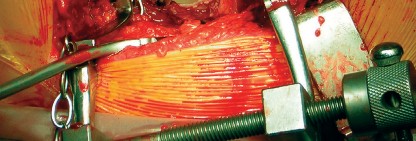 Illustration 26 for Cemented Component Longevity: The Critical Margin of the Acetabulum