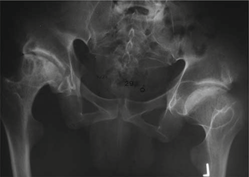 Illustration 2 for Understanding Multiple Epiphyseal Dysplasia: Orthopedic Cases