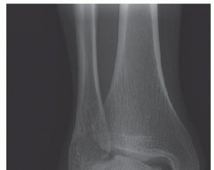 Deltoid Ligament Reconstruction: Restore Ankle Stability