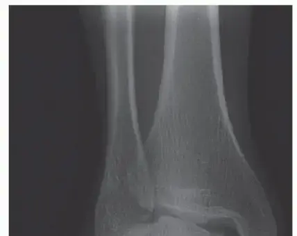 صورة توضيحية لـ جراحة ترميم الرباط الدالي في الكاحل: دليلك الشامل لاستعادة الثبات والحركة مع الأستاذ الدكتور محمد هطيف