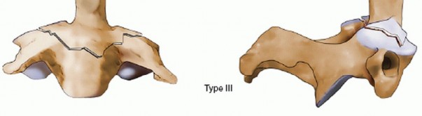 Illustration 9 for Master Techniques for Cervical Fracture Reduction: Type III & More