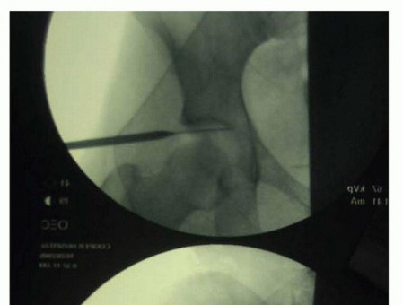 Illustration 18 for Hip Arthroscopy: Your Minimally Invasive Solution for Hip Pain