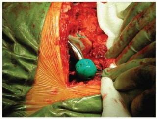 Illustration 35 for Why Polished Tapered Cemented Stems Excel in Hip Replacement