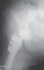 Illustration 17 for Advanced Arthroplasty for Malignant Lesions: Reclaim Your Mobility