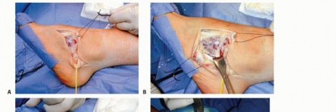 Illustration 30 for How Achilles Tendon Lengthening Fixes Equinocavovarus Foot