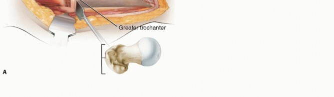 Illustration 12 for Proximal Femoral Osteotomy: When This Hip-Saving Surgery Is Performed
