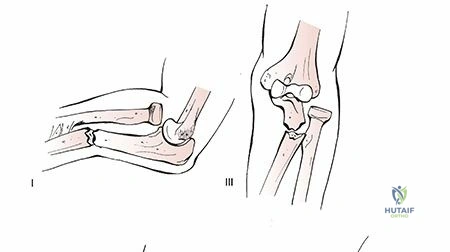 Mastering Radius & Ulna Shaft Fractures: Key Concepts Explained