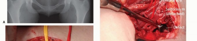 Illustration 36 for Pelvic Metastasis Surgery: A Component of the Utilitarian Approach