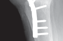 Illustration 4 for Optimize Tibial Component Alignment: Techniques for TKA Success