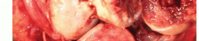 Illustration 21 for Distal Humeral Fractures: When Is Elbow Replacement the Best Option?