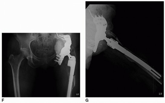 Illustration 5 for Custom Triflanged Devices: Solving Massive Acetabular Bone Loss