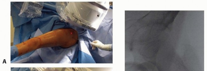 Illustration 9 for Pediatric Femoral Nailing: Targeting the Right aspect of the greater Trochanter