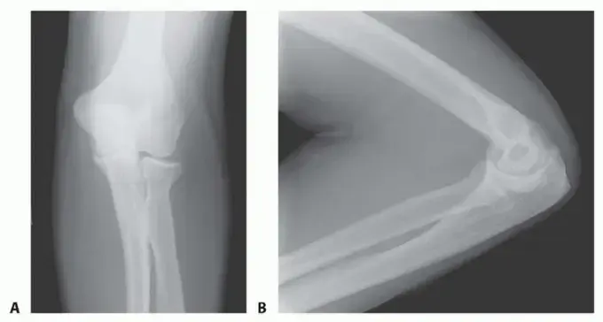 صورة توضيحية لـ تيبس الكوع: دليل شامل للمرضى لاستعادة حركة ذراعك مع الأستاذ الدكتور محمد هطيف