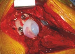 Illustration 15 for Revision THA: Acetabular Impaction Grafting for Severe Bone Loss