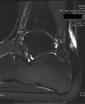 نقل وتر الإبهام الطويل (FHL) لعلاج تمزق وتر العرقوب المزمن: دليل شامل للمرضى مع الأستاذ الدكتور محمد هطيف