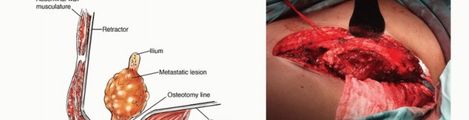Illustration 17 for Pelvic Metastasis Surgery: A Component of the Utilitarian Approach