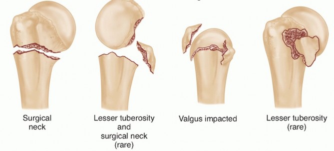 Illustration 2 for Optimizing Fixation of Proximal Humerus Fractures: A Guide