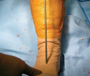 Illustration 16 for Minimally Invasive Subvastus: The Best Path to Quicker TKA Recovery