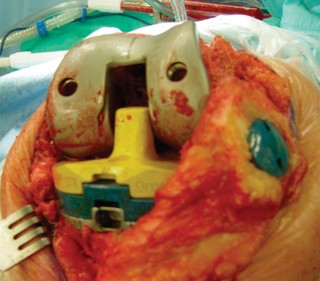 صورة طبية: مراجعة استبدال الركبة الجزئي الفاشل دليلك الشامل للعلاج الناجح في صنعاء