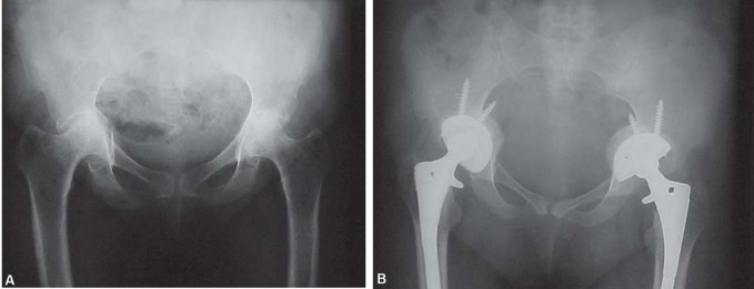 Illustration 38 for Total Hip Replacement for Protrusio: Restore Your Hip Function