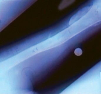 Illustration 13 for Arthrodesis with an Intramedullary Nail: Fixing Failed TKAs