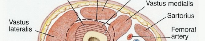 Illustration 2 for Advanced Distal Femoral Resections: Limb-Sparing Outcomes & Techniques