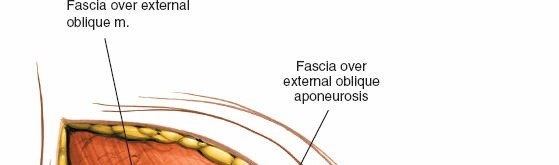 Illustration 5 for Ilioinguinal Approach: Master the Deep Inguinal Ring for Success