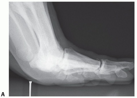 Illustration 10 for Restore Your Foot: Surgical Treatment for Hallux MP Joint Turf Toe