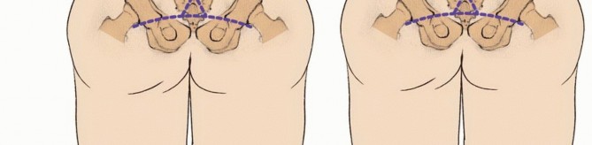 Illustration 23 for Sacral Tumor Surgery: Safeguarding Bowel & Bladder Control