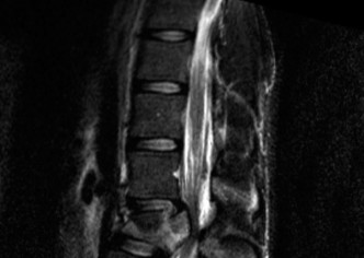 Illustration 21 for Adjacent Segment Degeneration: Your Next Spine Case Solved