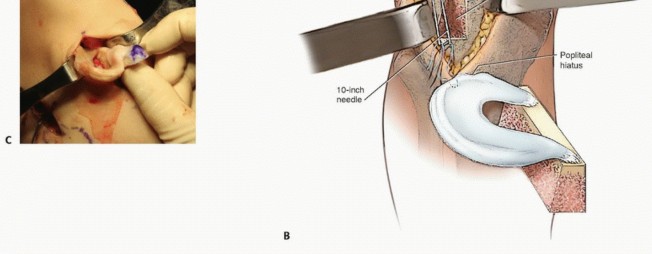 Illustration 18 for Symptomatic Knee? Meniscal Transplant for Anterior & Posterior Horns