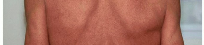 Illustration 5 for Decompressing the Transverse Scapular Ligament for Shoulder Pain Relief