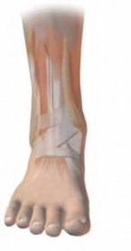 Illustration 30 for Optimizing ORIF for Tibial Plafond Fractures: A Modern Approach