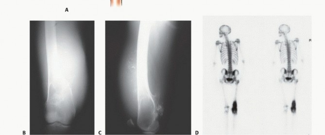 Illustration 13 for Advanced Distal Femoral Resections: Limb-Sparing Outcomes & Techniques