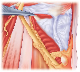 Illustration 28 for Mastering Valgus Total Knee Replacement: Techniques & Pitfalls