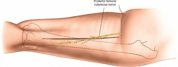 Illustration 36 for Optimal Femoral Approaches: Mastering the Lateral Intermuscular Septum