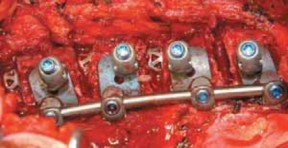 Illustration 47 for Mastering Anterior Interbody Arthrodesis with Instrumentation for Scoliosis