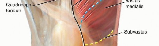 Illustration 7 for Achieve Lasting Pain Relief with Cemented Total Knee Arthroplasty