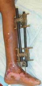 Illustration 8 for Pediatric Tibial Fractures: Avoid Mistakes, Ensure Optimal Healing