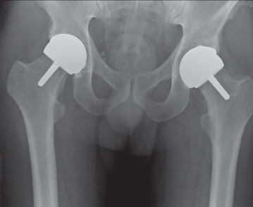 Illustration 77 for Metal on Metal Resurfacing: Enhanced Posterior Soft Tissue Repair