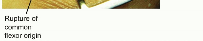 Finally End Golfer's Elbow Pain: Open Treatment of Medial Epicondylitis