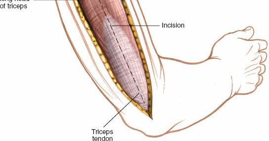 Illustration 37 for Mastering the Approach to the Distal Humerus: Safety & Skills