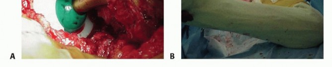 Illustration 16 for Cemented Total Hip: A Successful & Evidence-Based Solution