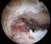 Illustration 25 for Arthroscopic Subscapularis Repair: The lo iky brady Method for Stability
