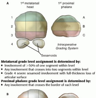 Illustration 9 for End Articular Cartilage Loss: Arthrosurface HemiCAP Resurfacing